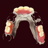 金属床義歯