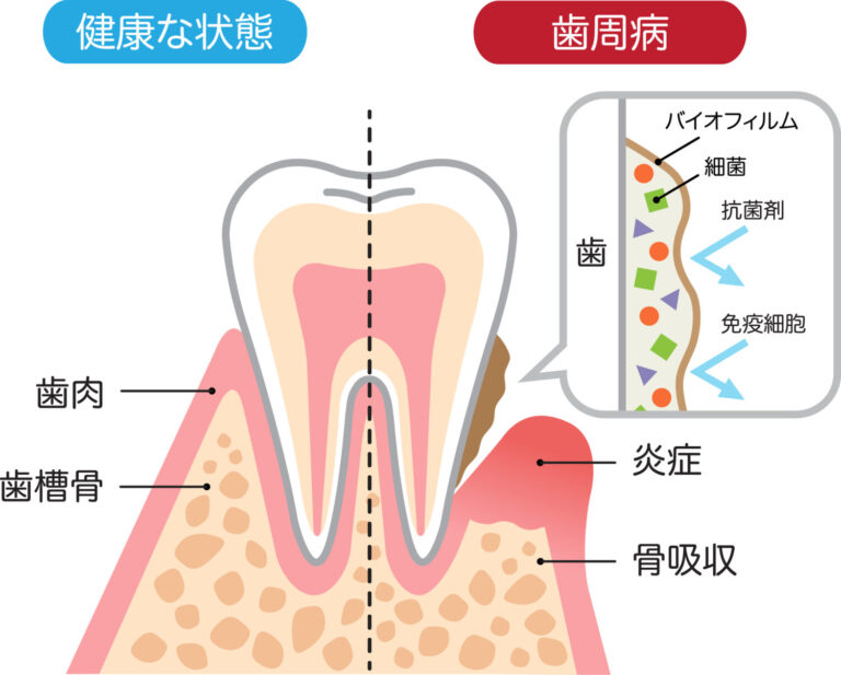 歯周病と全身疾患の関係