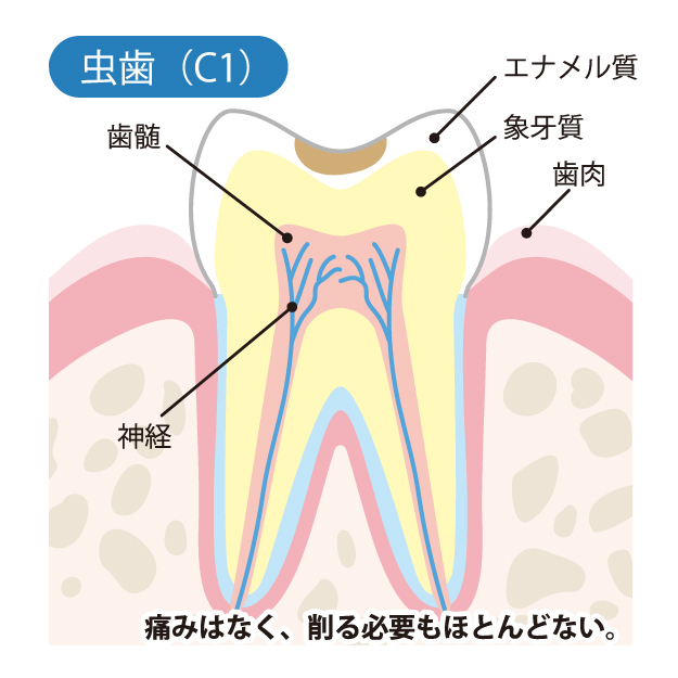 C1（エナメル質の虫歯）