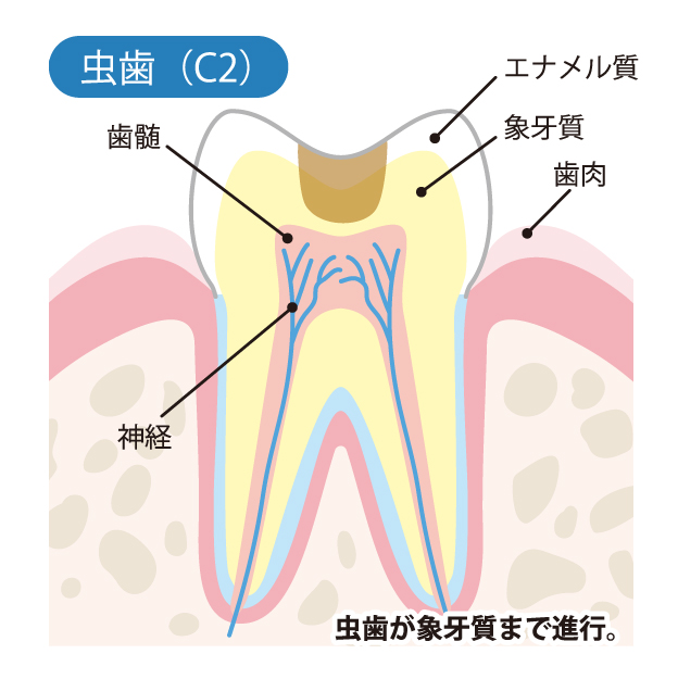 C2（象牙質の虫歯）