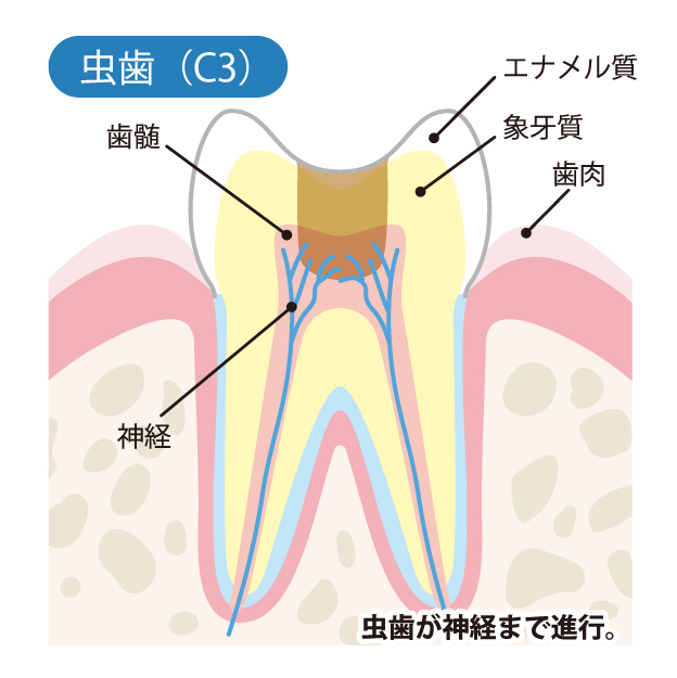 C3（神経に達した虫歯）