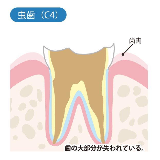 C4（末期の虫歯）