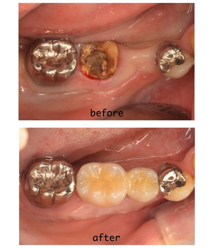 【症例】50代女性：右下奥歯の虫歯および欠損に対するインプラント治療（抜歯即時埋入・骨造成・遊離歯肉移植術）
