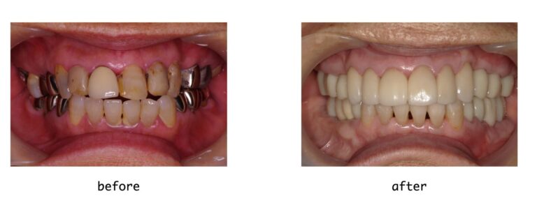 包括的歯科治療　６０代　女性　インプラント治療を希望