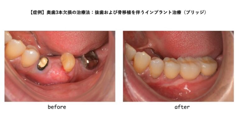 【症例】奥歯3本欠損の治療法：抜歯および骨移植を伴うインプラント治療（ブリッジ）
