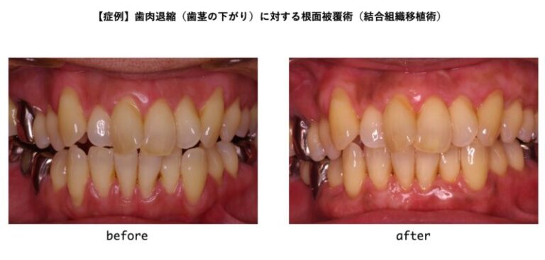 【症例】歯肉退縮（歯茎の下がり）に対する根面被覆術（結合組織移植術）