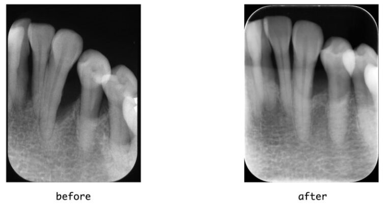 【症例】重度歯周炎に対する歯周組織再生療法（エムドゲイン・骨移植）