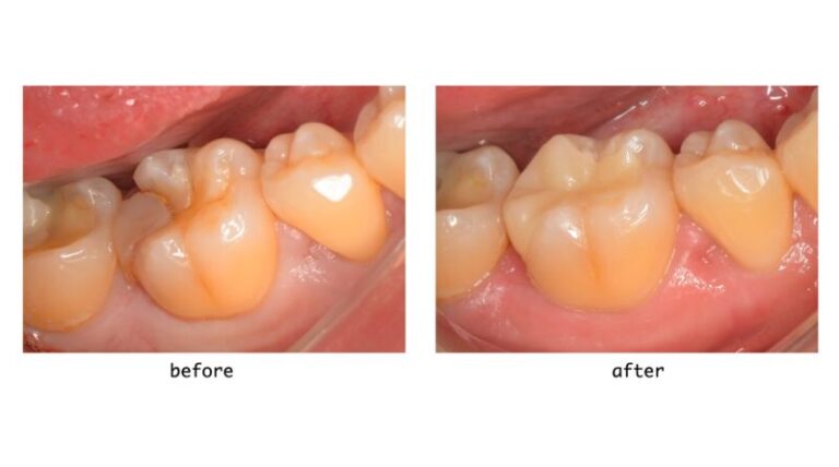 【症例】欠けた奥歯の詰め物をジルコニアインレーで修復・30代男性