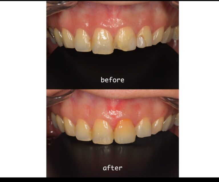 【症例】欠けた前歯をオールセラミッククラウンで修復・40代／女性